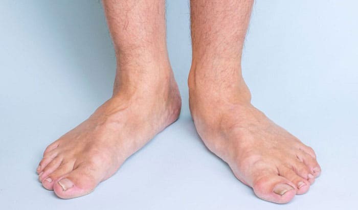 Why Are Flat Feet Not Allowed in the Military? (Detailed Explanation)